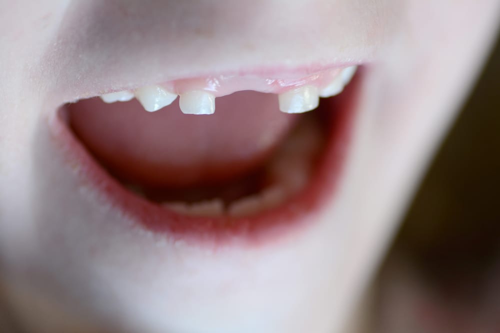Little Child Smiling Missing Front Tooth